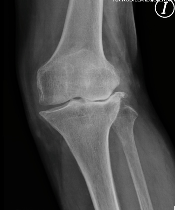 La Radiografía de Rodilla: Una Ventana Esencial a la Salud Articular Gonartrosis y Genu valgo
