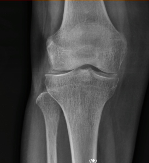 La Radiografía de Rodilla: Una Ventana Esencial a la Salud Articular Condrocalcinosis de meniscos