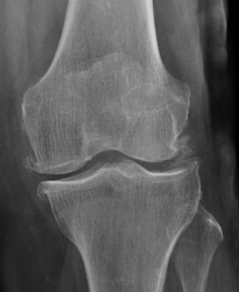 La Radiografía de Rodilla: Una Ventana Esencial a la Salud Articular Enfermedad por depósito de cristales de pirofosfato