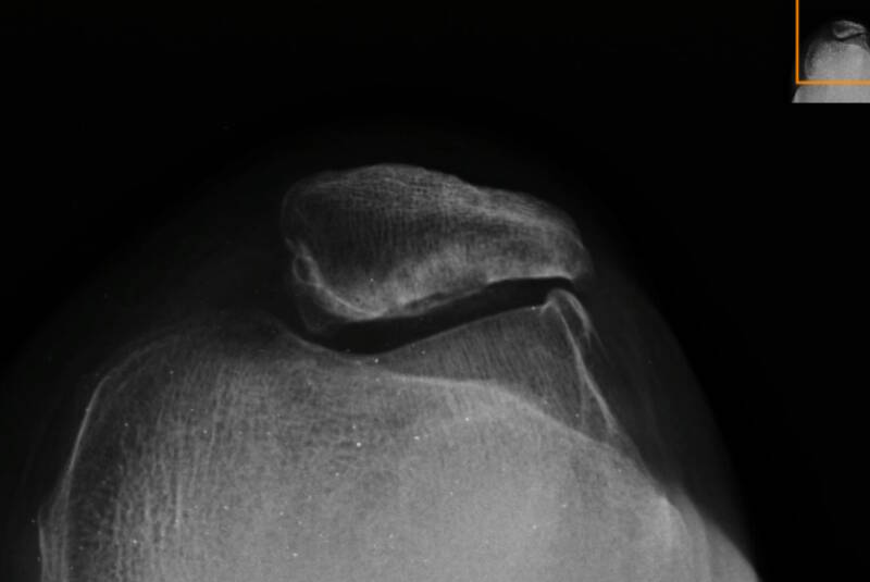 La Radiografía de Rodilla: Una Ventana Esencial a la Salud Articular Condromalacia patelar