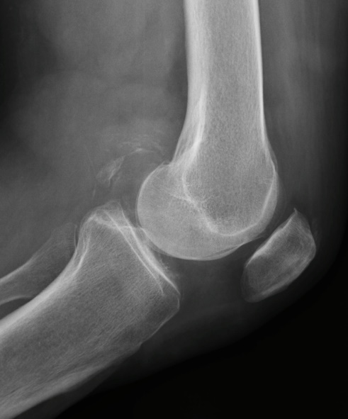 La Radiografía de Rodilla: Una Ventana Esencial a la Salud Articular Sinovitis calcificada