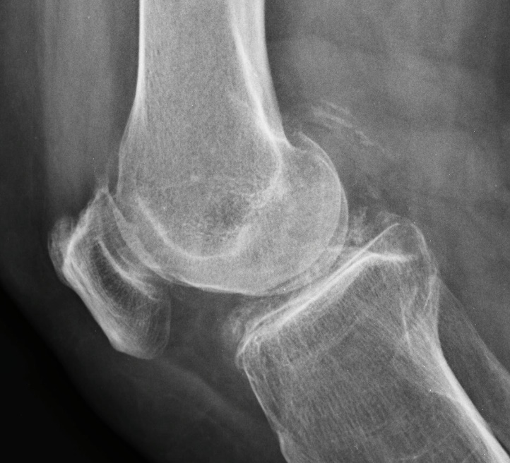 La Radiografía de Rodilla: Una Ventana Esencial a la Salud Articular Tendinosis suprapatelar