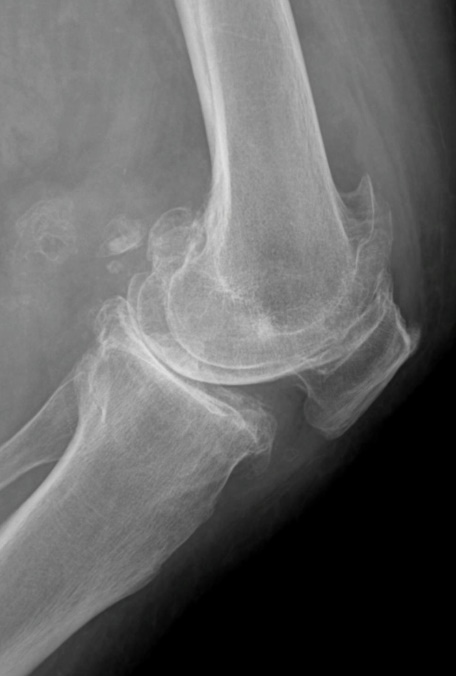 La Radiografía de Rodilla: Una Ventana Esencial a la Salud Articular Gonartrosis con cuerpos óseos libres intaarticulares
