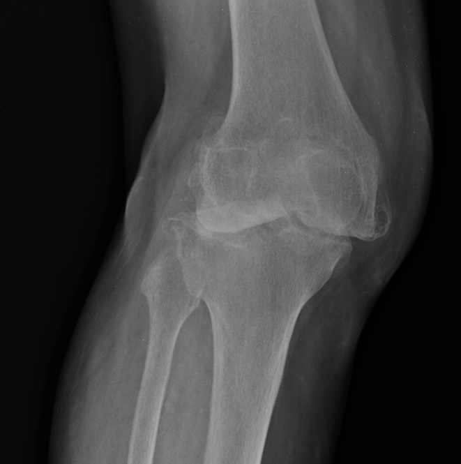 La Radiografía de Rodilla: Una Ventana Esencial a la Salud Articular Erosiones subcondrales