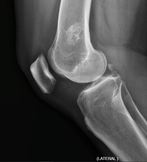 La Radiografía de Rodilla: Una Ventana Esencial a la Salud Articular Infarto óseo femoral distal