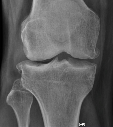 La Radiografía de Rodilla: Una Ventana Esencial a la Salud Articular osteoscondritis
