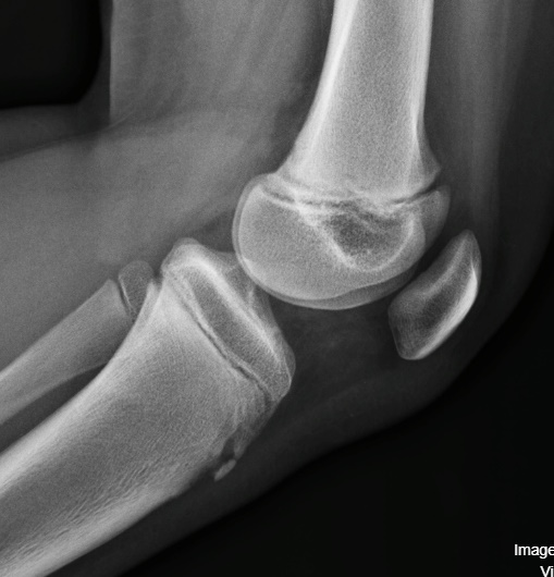 La Radiografía de Rodilla: Una Ventana Esencial a la Salud Articular Osteocondritis de Oddsgoodslater