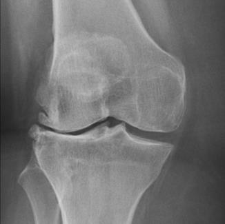 La Radiografía de Rodilla: Una Ventana Esencial a la Salud Articular osteofitos laterales externos a la rodilla con disminución de espacio de compartimiento externo