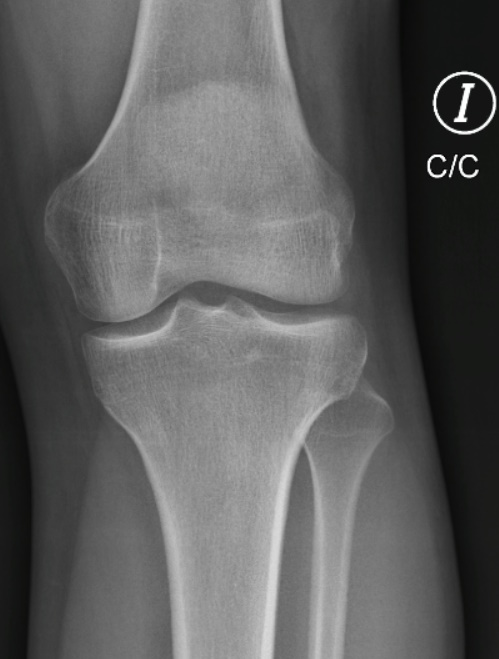 La Radiografía de Rodilla: Una Ventana Esencial a la Salud Articular Radiografía de rodilla en proyección AP normal