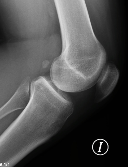 La Radiografía de Rodilla: Una Ventana Esencial a la Salud Articular Radiografía de rodilla normal en proyección lateral
