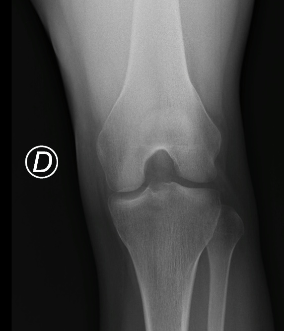 La Radiografía de Rodilla: Una Ventana Esencial a la Salud Articular Radiografía de rótula en proyección de Rosenberg