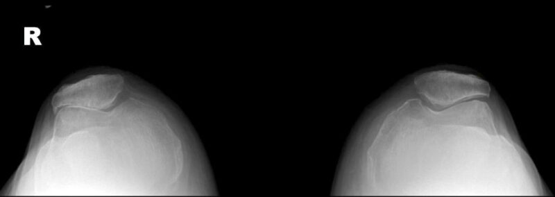 La Radiografía de Rodilla: Una Ventana Esencial a la Salud Articular Condromalacia patelar (osteoartrosis)
