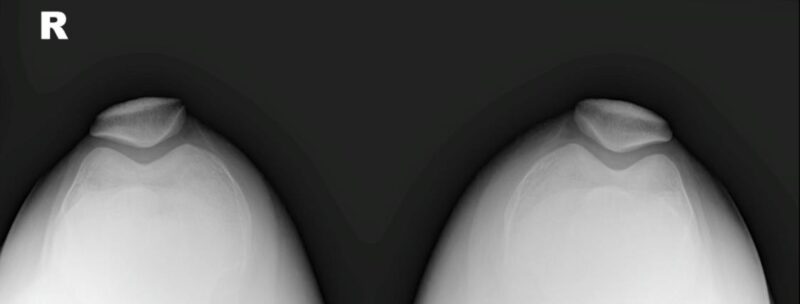 La Radiografía de Rodilla: Una Ventana Esencial a la Salud Articular radiografía axial normal de rótulas