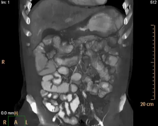 Tomografía de abdomen