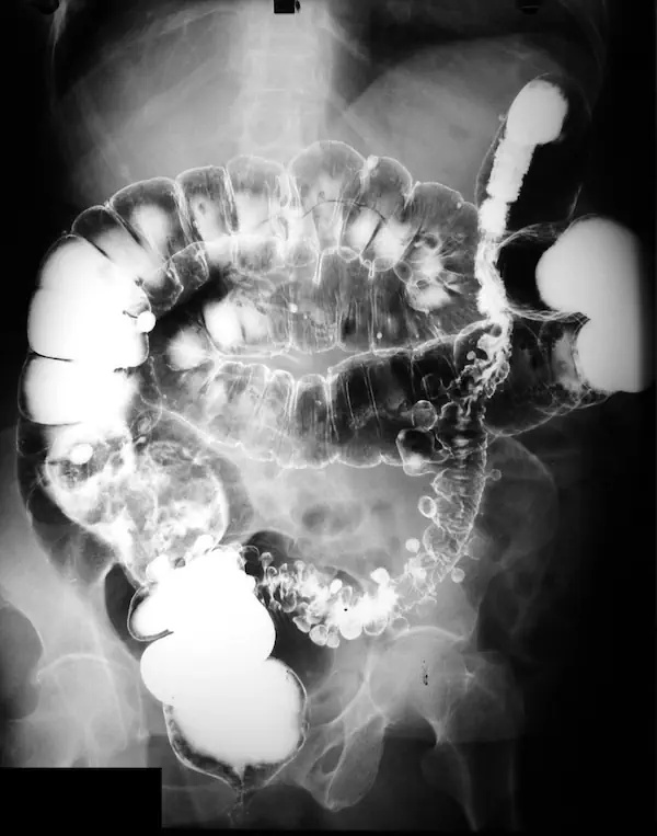 Colon por Enema y Colon por Ostomía: Los secretos detrás del Estudio Radiológico Colon por Enema con Diverticulos