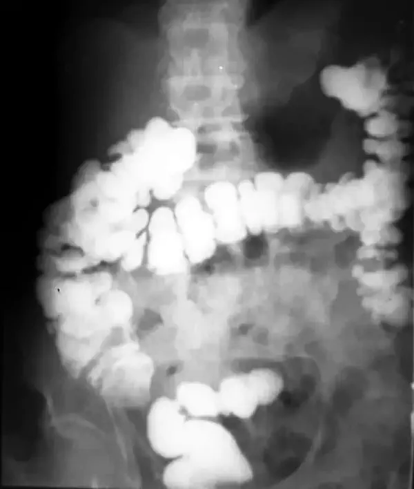 Colon por Enema y Colon por Ostomía: Los secretos detrás del Estudio Radiológico Colon por Ostomia con contraste hidrosoluble
