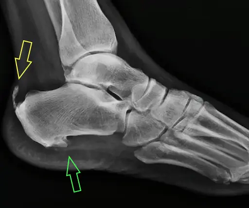Radiografía del Pie: Proyecciones y Enfermedades Comunes Radiografía lateral de pie con espolón óseo calcáneo y tendinosis aquileana.