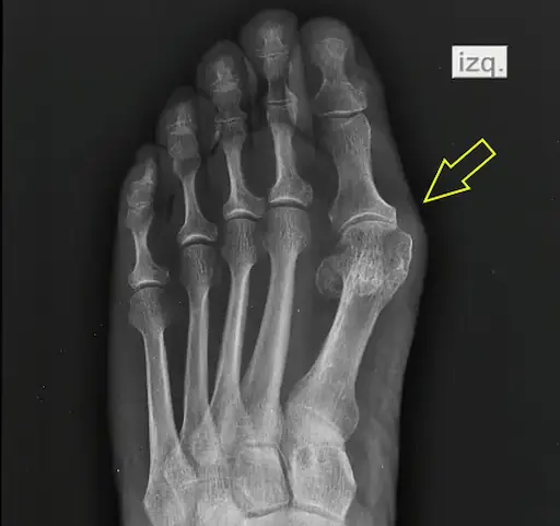 Radiografía del Pie: Proyecciones y Enfermedades Comunes Radiografía del pie con imagen de Hallux Valgus
