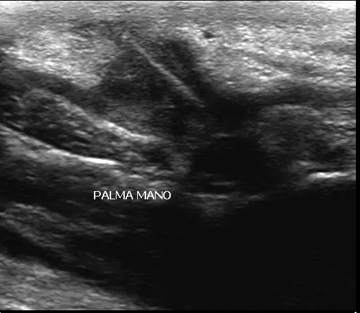 El Eco de Partes Blandas Eco de partes blandas de la palma de la mano donde se observa un cuerpo extraño incrustado