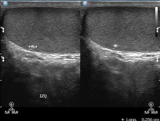 El Eco de Partes Blandas Ultrasonido testicular