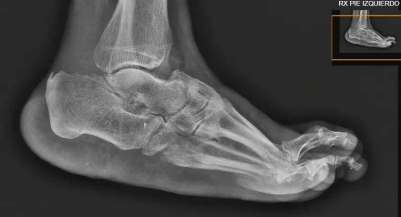 Radiografía del Pie: Proyecciones y Enfermedades Comunes Pie Plano y Artropatía de Charcot