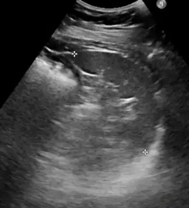 El Ecosonograma Abdominal, información a pacientes Ultrasonido Abdominal - Bazo Normal