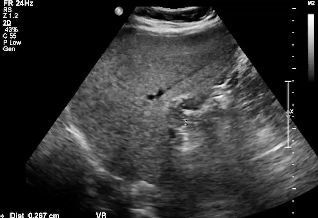 El Ecosonograma Abdominal, información a pacientes Ecosonograma abdominla - Higado