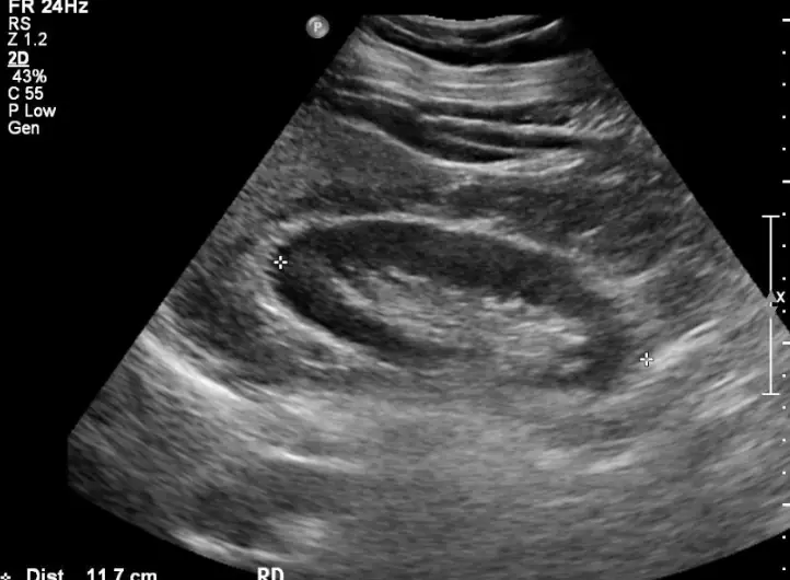 El Ecosonograma Abdominal, información a pacientes Ultrasonido abdominal - Evaluación Renal
