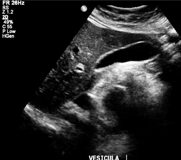 El Ecosonograma Abdominal, información a pacientes Ecosonograma abdominal - Vesícula Biliar