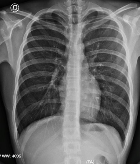 Estudios de imagen - Rx. Tórax normal