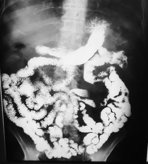 Estudios de Imagen - Transito intestinal